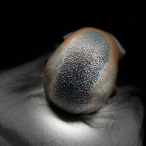 Técnica Avançada de Transplante Capilar FUE