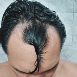 Antes-do-transplante-FUE-paciente-2.png