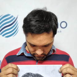 Depois-do-transplante-FUE-paciente-2.png