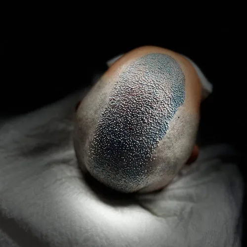 Técnica Avançada de Transplante Capilar FUE